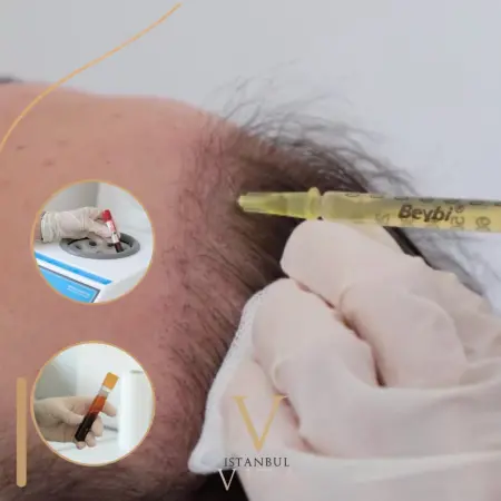 PRP Hair Treatment in Turkey 2026: Cost & Sessions