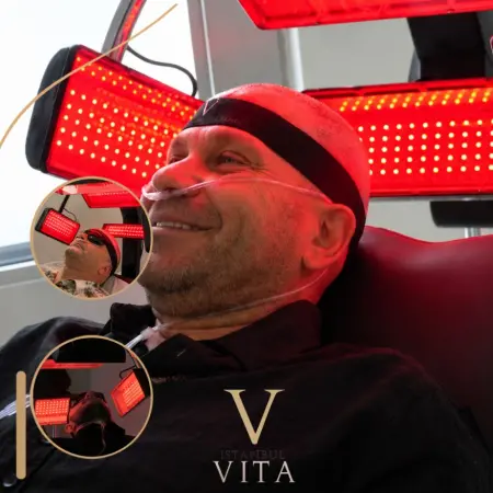 Terapia de Luz Roja Tras el Trasplante Capilar (LLLT)