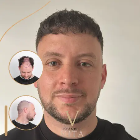 Hair Transplant Recovery Timeline: Healing and Results