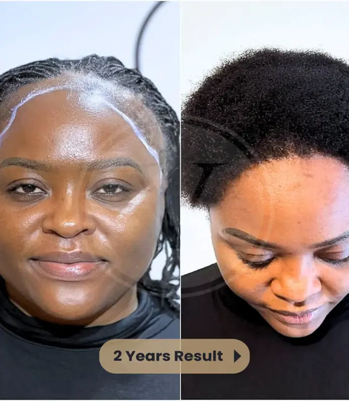 Afro Hair Transplant Results Before & After