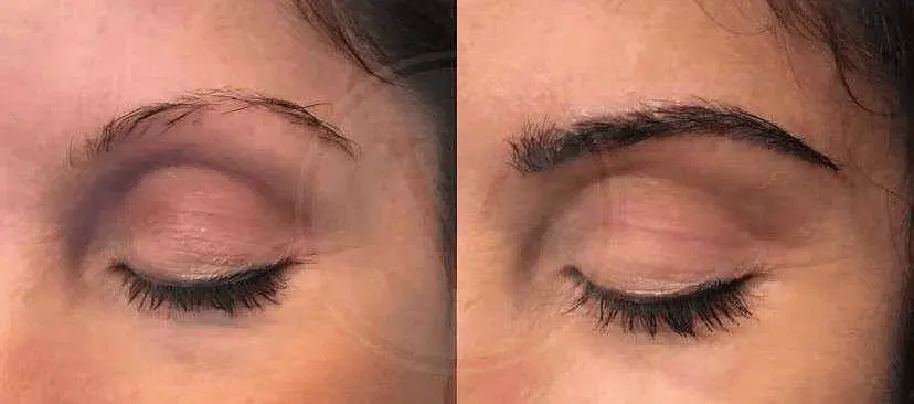 EyebrowHairTransplantBeforeAfter1