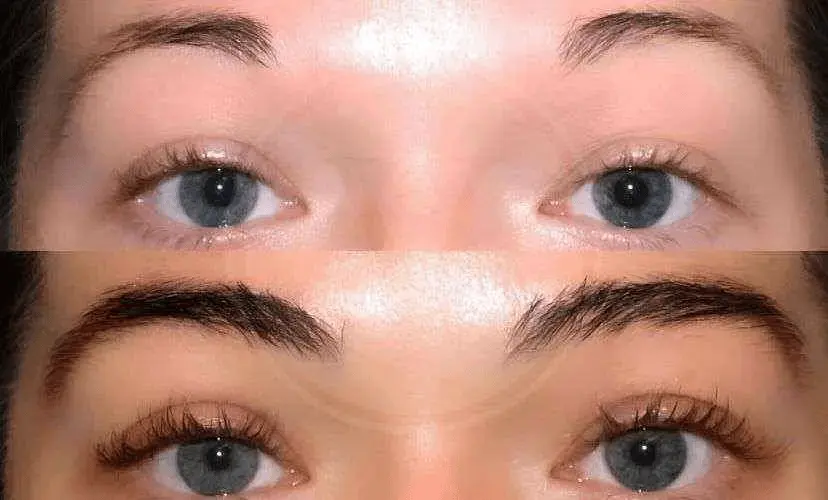 EyebrowHairTransplantBeforeAfter2