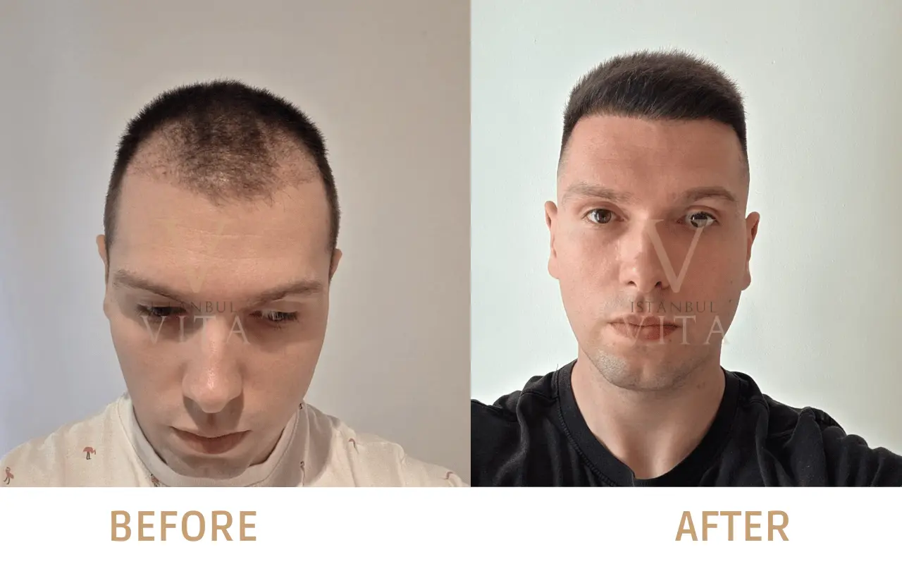 the before and after hair results of combined fue and dhi hair transplant 