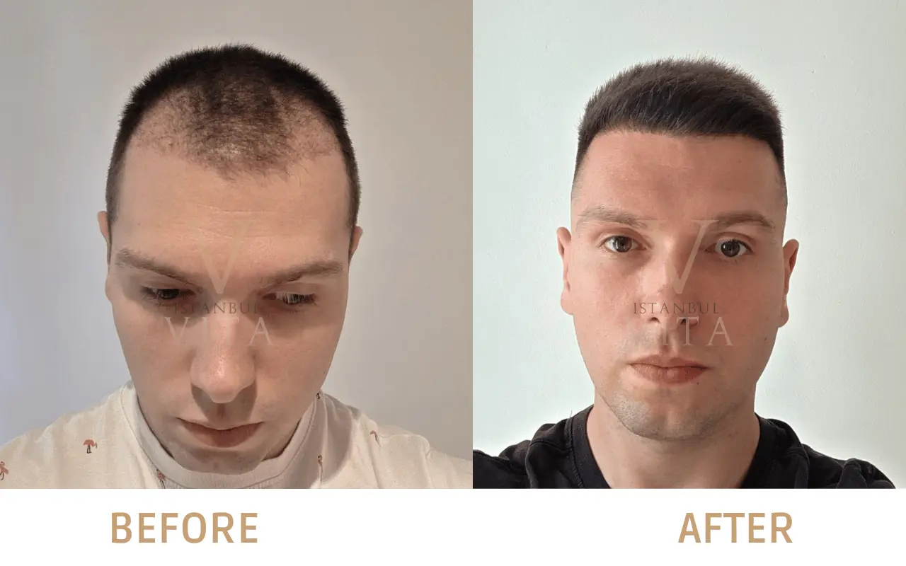Résultats Avant et Après une Greffe de Cheveux Combinée