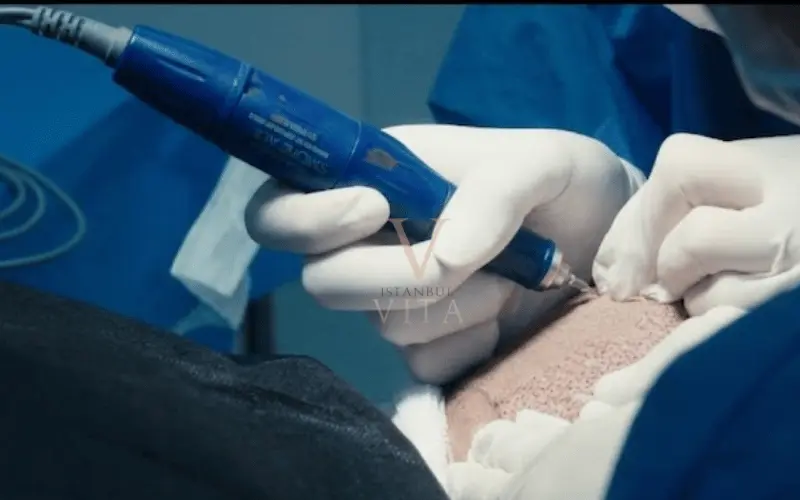Doctor sosteniendo un bolígrafo implante Choi para trasplante capilar