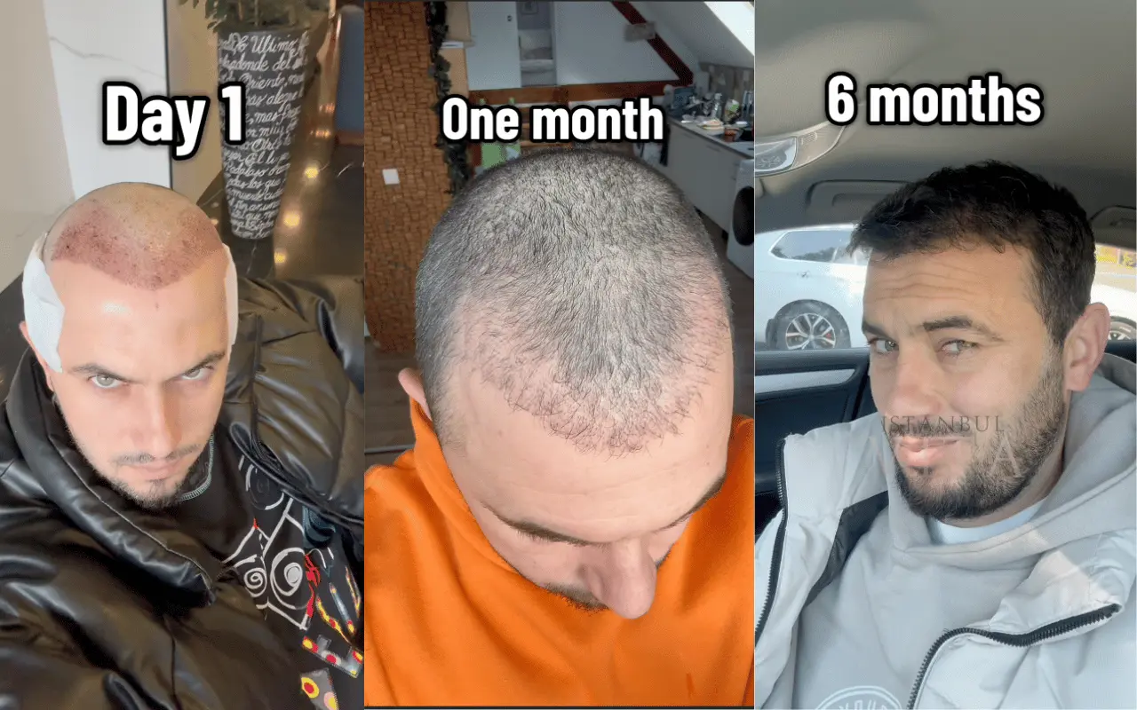day 1 to 6 months recovery photos after dhi hair transplant 
