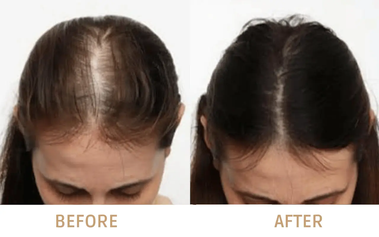 Risultati del trapianto di capelli DHI per diradamento diffuso femminile: prima e dopo