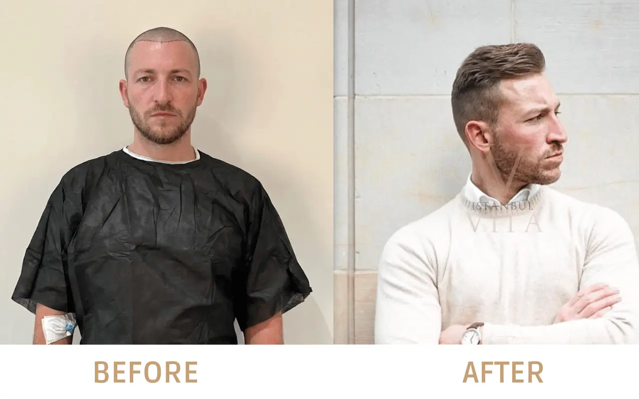 un hombre con resultados de antes y después de un trasplante capilar DHI