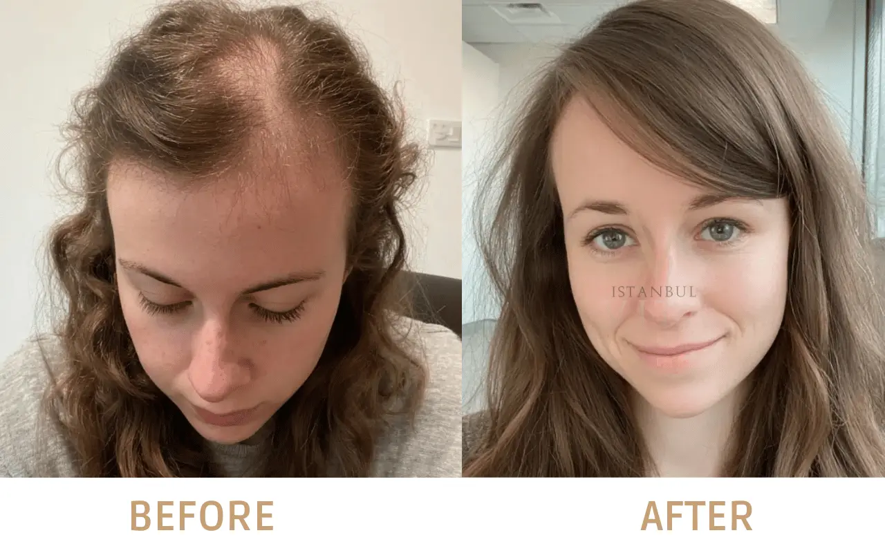 una mujer con resultados de antes y después de un trasplante capilar DHI