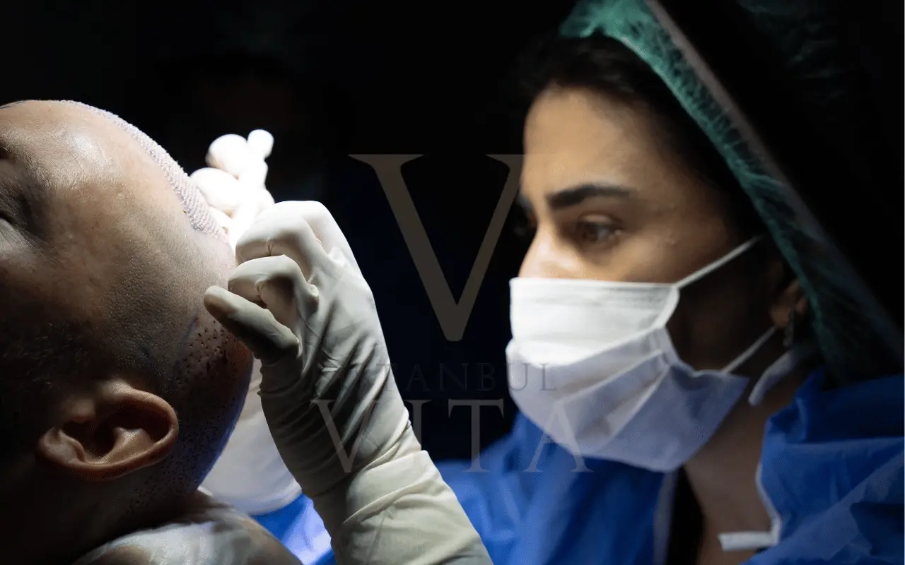 Choi implanter kalemi tutarak saç ekimi yapan bir doktor