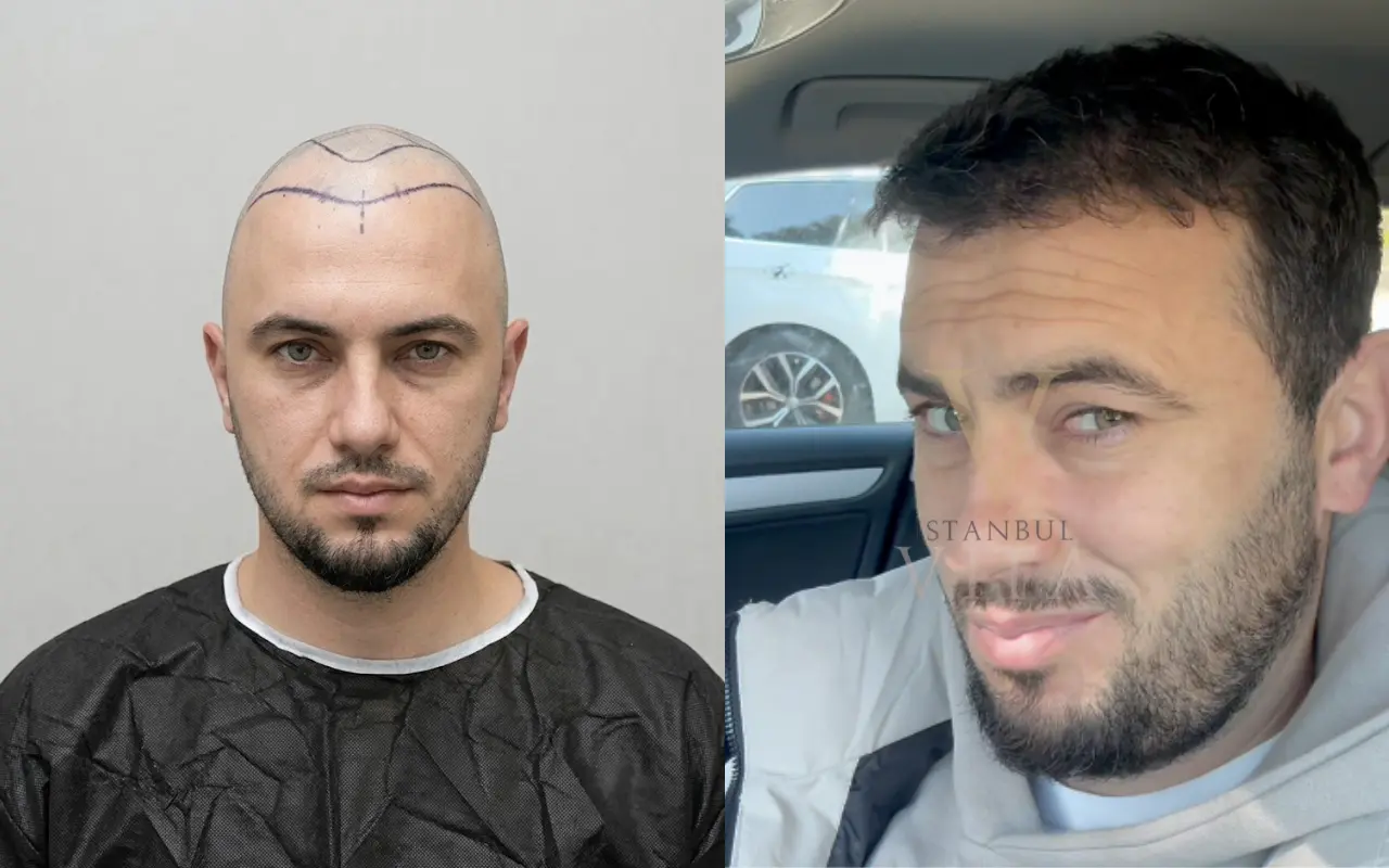 Risultati prima e dopo del trapianto di capelli con tecnica FUE Zaffiro