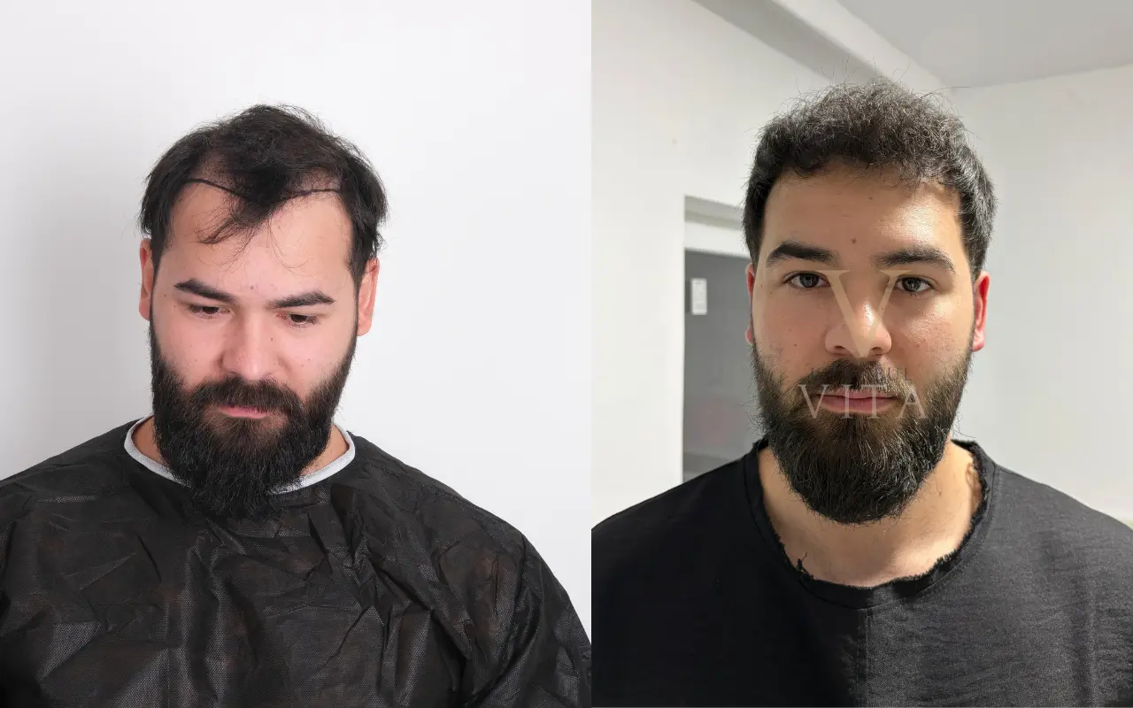 Résultats avant et après d’une greffe de cheveux FUE Saphir