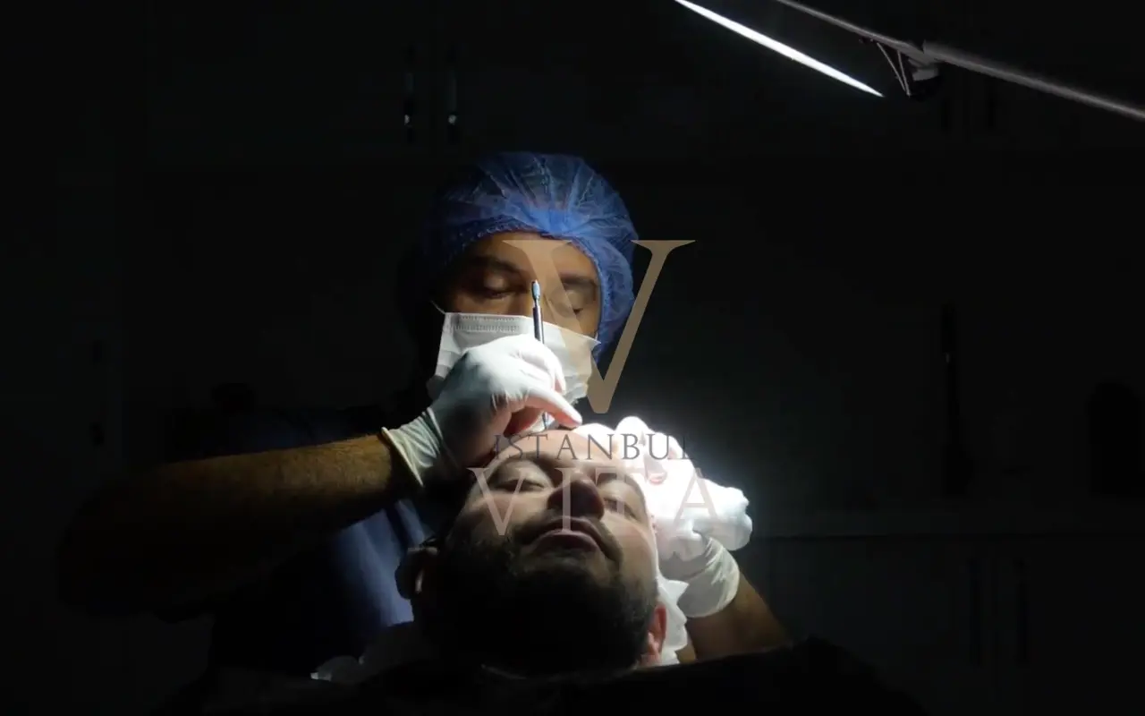 Medic efectuând un transplant de păr Sapphire FUE