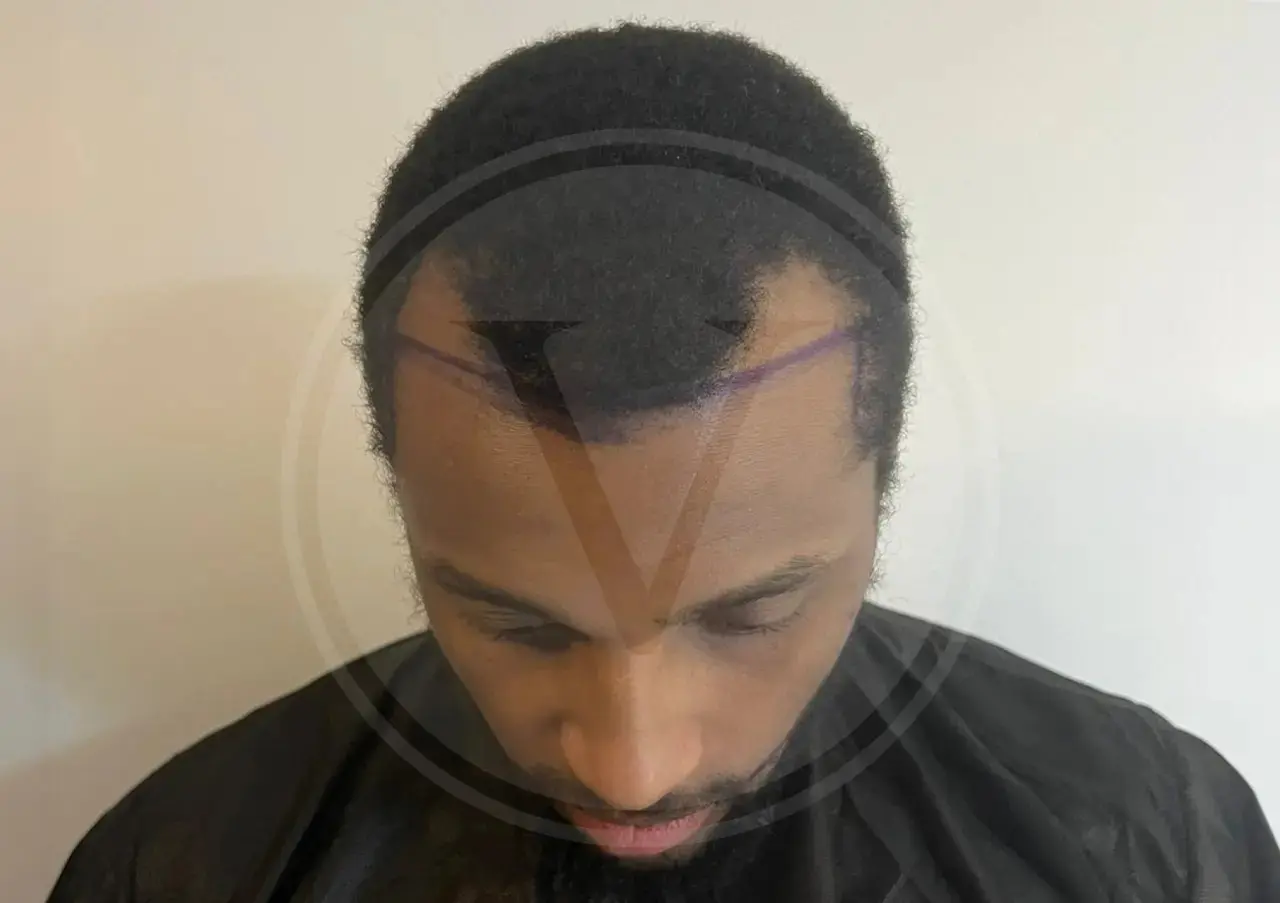 afro hair transplant
