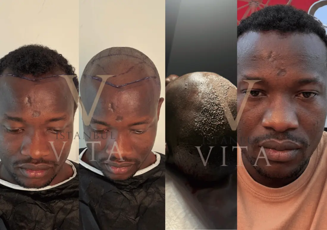 Afro hair transplant before and after at Istanbul Vita: hairline planning and final result
