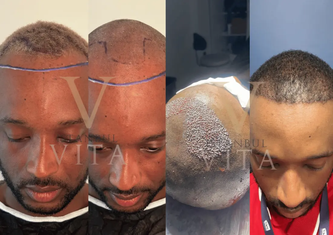 Afro hair transplant patient at Istanbul Vita: donor area, implantation day and grown result