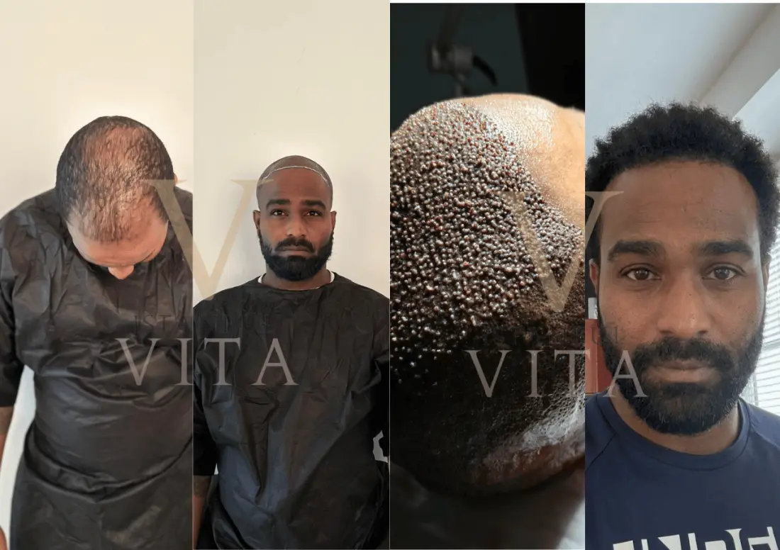 Afro hair transplant procedure at Istanbul Vita, step by step from planning to result