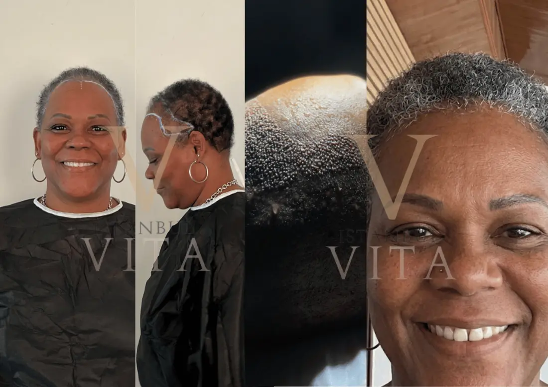 Afro hair transplant before and after result from Istanbul Vita Clinic in Istanbul