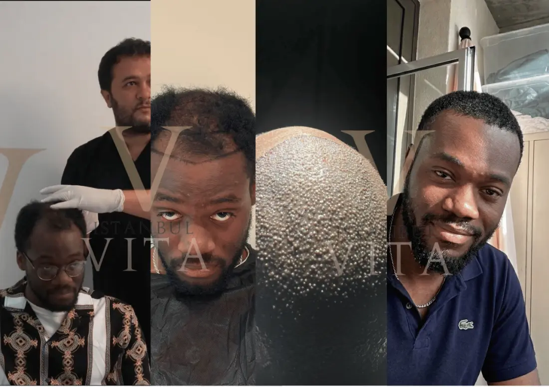 Afro textured hair transplant result at Istanbul Vita after full growth